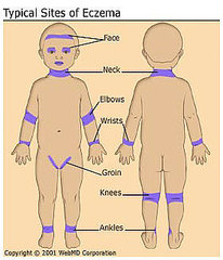 Treatment of Baby Eczema