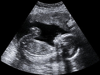 Laws That Bully Women Seeking Abortions