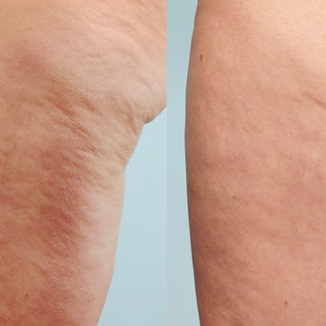 Cellulaze One-Time Cellulite Treatment Is FDA-Approved