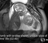 Twins Fighting in Womb, Captured on Video!