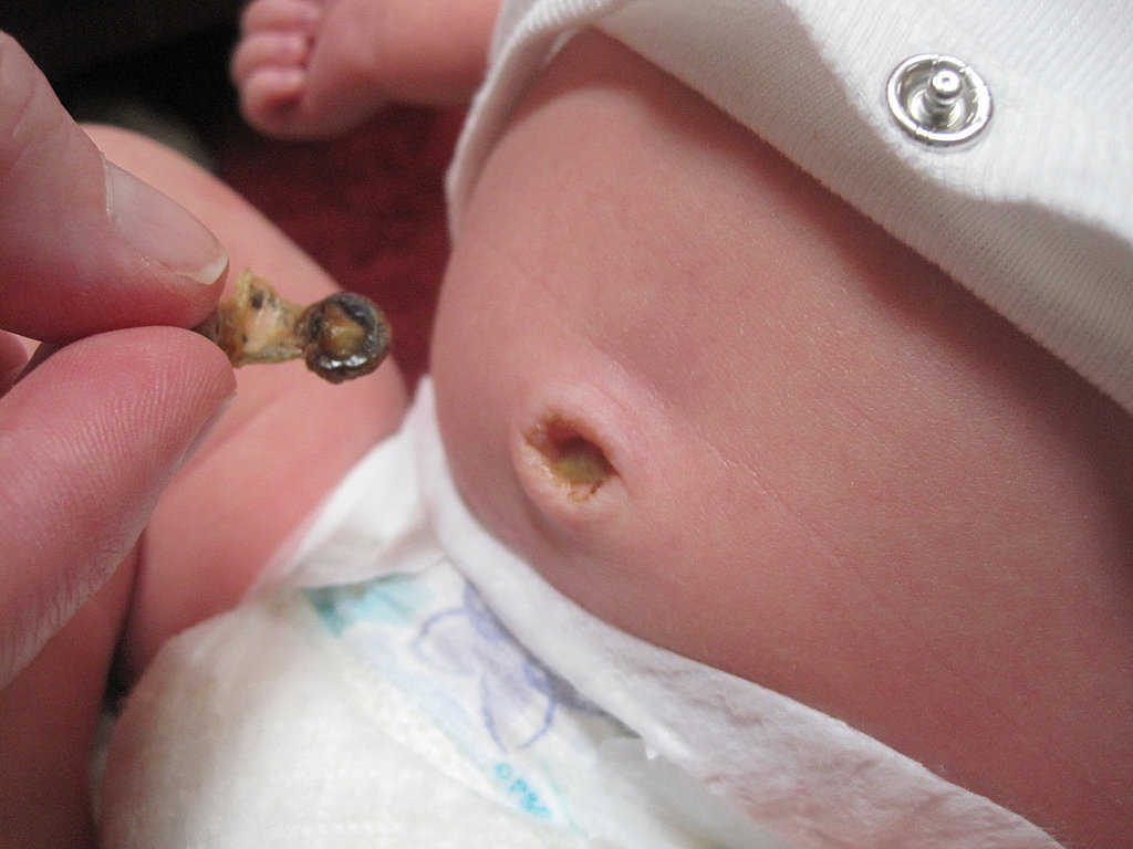 Umbilical Cord Umbilical Cord
