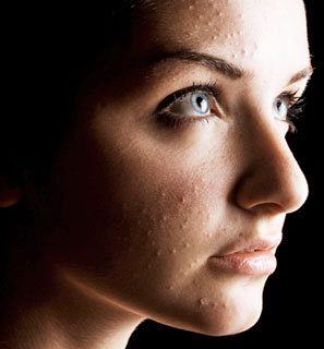 Causes of Acne