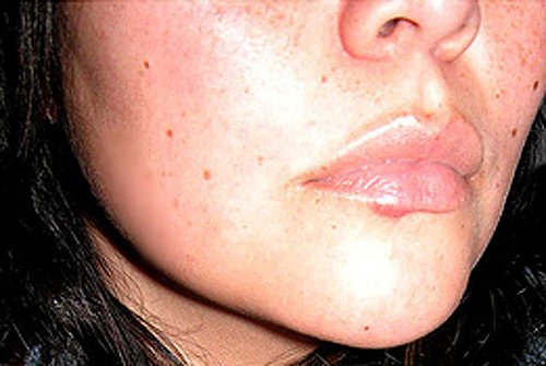How to Prevent Cold Sores