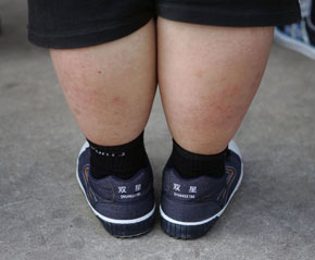 Mom Arrested for Obese Child Under Child Neglect