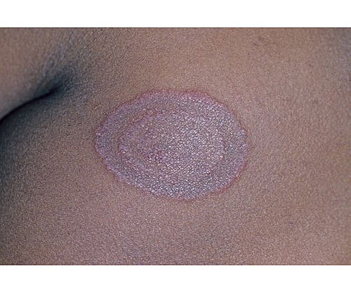 Ringworm Ringworm