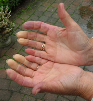 Raynaud's Disease