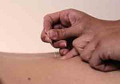 Got Cramps? Try Acupuncture
