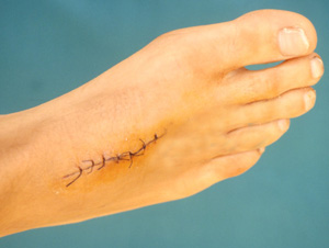 Speak Up: Have You Ever Had Stitches?
