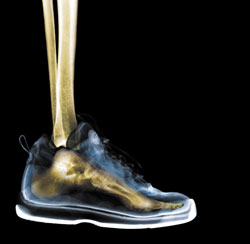 A Pain in Heel: Plantar Fasciitis