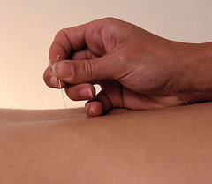 Acupuncture for Infertility