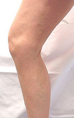 What are varicose veins? What are varicose veins?