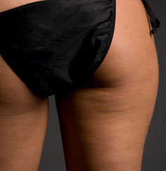 Five Facts About Cellulite