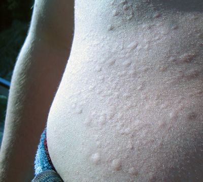 Swimmer's Issue: Allergy to Cold Water?