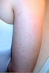 You Asked: Should I Worry About These Bumps on My Arm? 