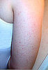 You Asked: Should I Worry About These Bumps on My Arm? 