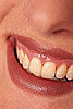Professional Teeth Whitening: What You Should Know