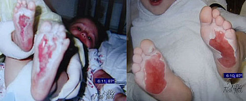 Who Is Responsible for 2nd Degree Burns on Kids' Feet?  