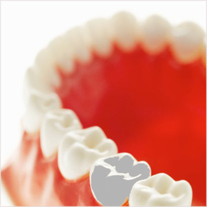 Pregnancy Mercury Fillings