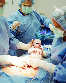 C-Section Quiz