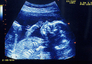 Law to Require Woman to Look at Baby Right Before Abortion 