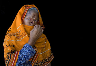 Burn Victims in Pakistan