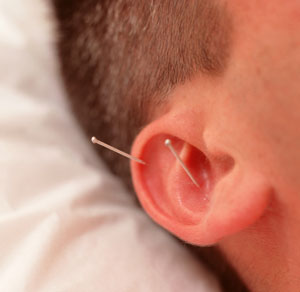 Acupuncture Relieves Tension Headaches