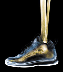 How to Prevent Shin Splints 2009-03-27 10:00:00