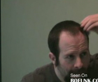 Guy Glues Beard Clippings to His Bald Spots