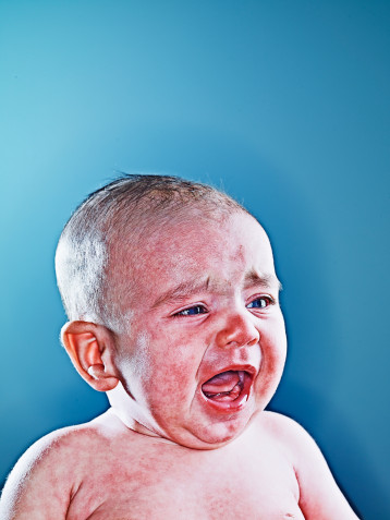 Allergic Reactions Allergic Reactions