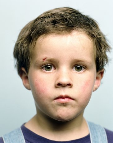 6 Tips for Identifying A Childhood Head Injury 6 Tips for Identifying A Childhood Head Injury