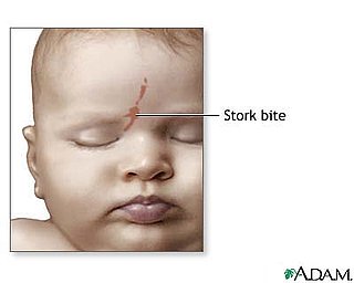 Birthmarks and Stork Bites