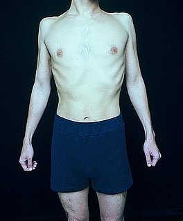 Men Who Struggle With Eating Disorders
