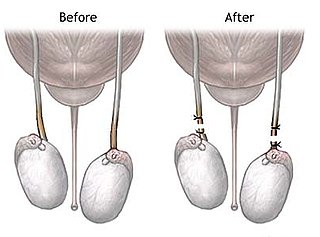 What Do You Know About the Unloved Vasectomy? 