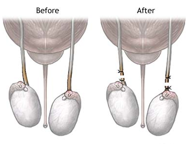 What Do You Know About the Unloved Vasectomy? 