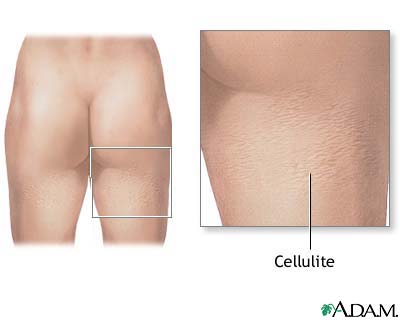 How to reduce Cellulite