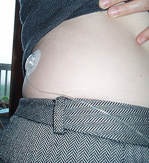 Diabetic Woman Explains the Pros and Cons of Switching to an Insulin Pump
