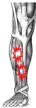 How Can I Prevent Shin Splints?