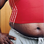 Tips for Stretch Mark Prevention