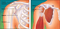 Torn Rotator Cuff = Painful Shoulder