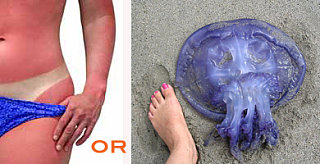 Sunburn or Jellyfish Sting: Which is Worse?