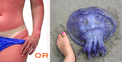 Sunburn or Jellyfish Sting: Which is Worse?