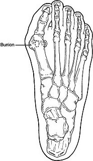 Got Bunions?