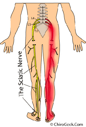What's the Deal With:  Sciatica