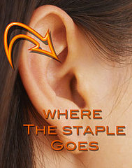 I Don't Buy It: Ear Stapling for Weight Loss