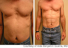 Six-Pack Surgery? Six-Pack Surgery?