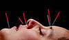 A Little Bit About The Benefits of Facial Acupuncture