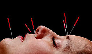 A Little Bit About The Benefits of Facial Acupuncture