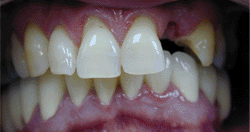 I Need A New Tooth!